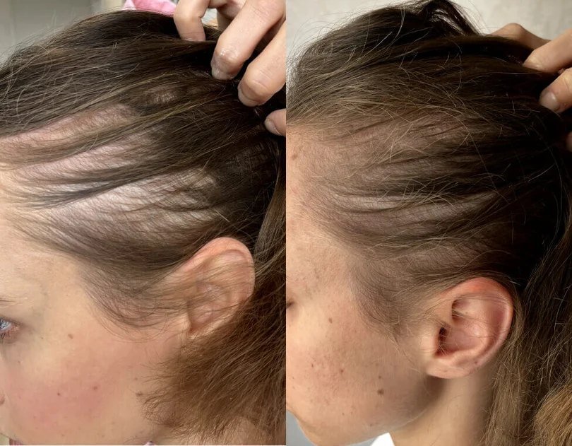 Crowned customer photo showing part line and crown area