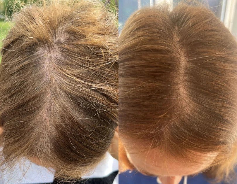 Crowned customer photo applying the dropper serum to the scalp